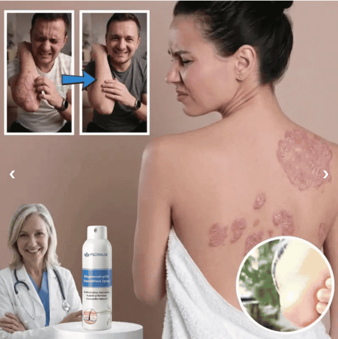 Psoralix™ Hautpflegespray | Lindert Schuppenflechte-Beschwerden in nur 3 Tagen!
